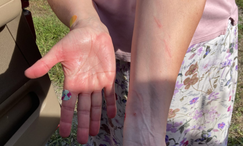 A close-up of a person's hand and forearm showing multiple red scratch marks from handling a wild kitten